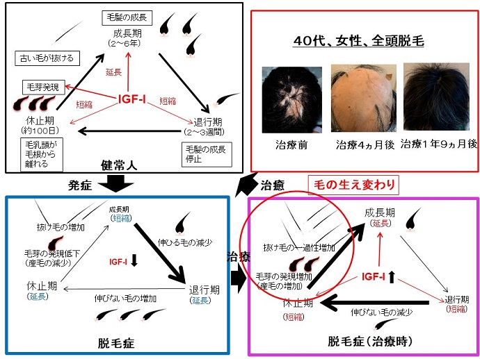 円形脱毛症　病院